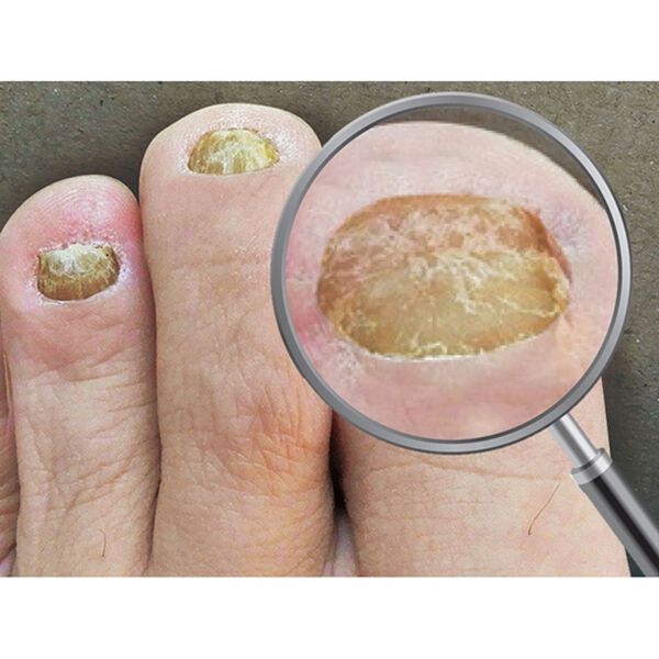 「薬用ジェル　ツメキラリ２本組（その他日用品）」｜詳細画像